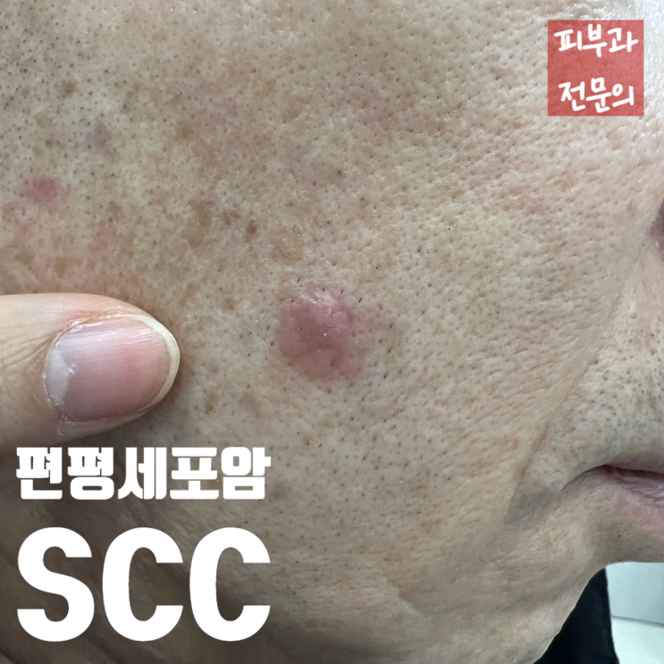  혼자 모양이 다르던 사마귀, 암이었다구? 편평세포암(SCC)