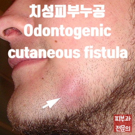  얼굴 종기인 줄 알았는데, 잇몸감염 때문이라구? 치성피부누공(Odontogenic cutaneous fistula)