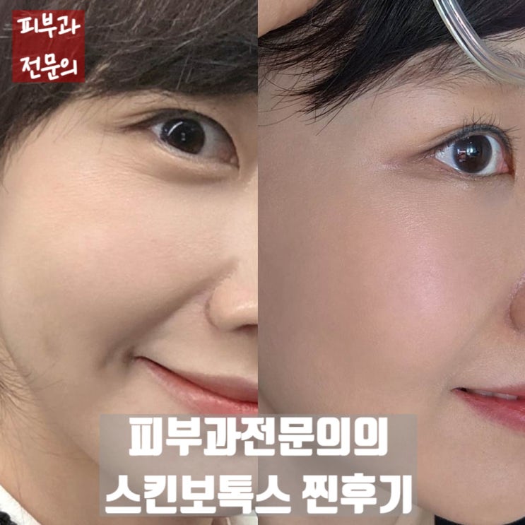  피부과전문의의 스킨보톡스 찐후기. 평생 미용시술을 한가지만 할 수 있다면, 내가 선택할 시술은?