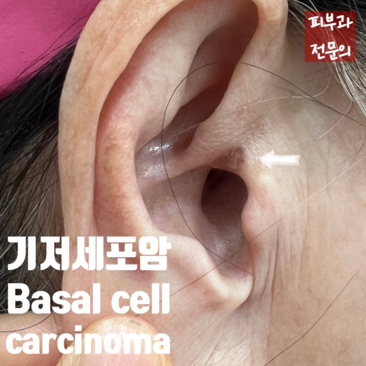  귀의 상처가 낫지 않아요... 기저세포암 (Basal cell carcinoma)