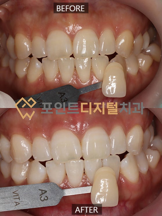 [탕정역치과]  오스템 뷰티스 원데이 치아미백 케이스(30대 여성) / 천안 아산 불당 배방