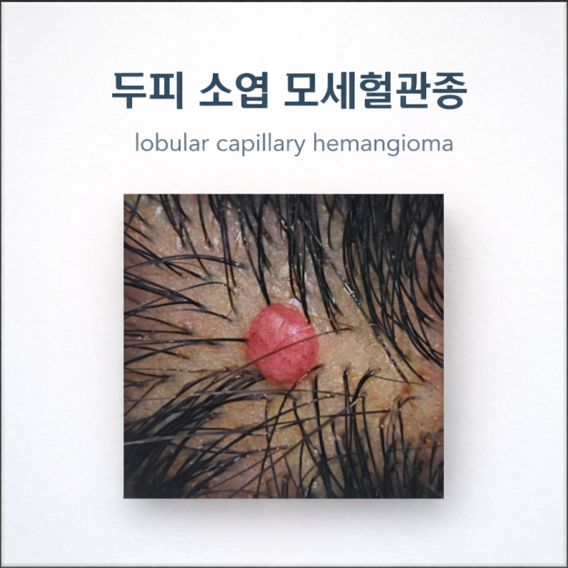 머리 두피에 빨깧게 올라온 혹, 두피혈관종, 화농성육아종