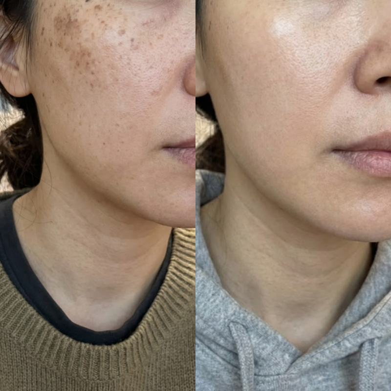 아이소이 흔적크림 트라넥삼산 백광크림 세럼 비교 후기