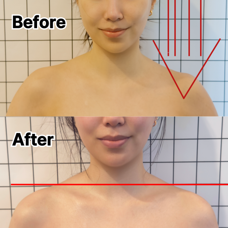  대구 비대칭관리 후기 얼굴라인 진짜 달라진 리얼 변화 선드린에스테틱