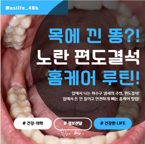 입냄새 원인 편도결석, 집에서 안전하게 빼는법 & 가글 추천!