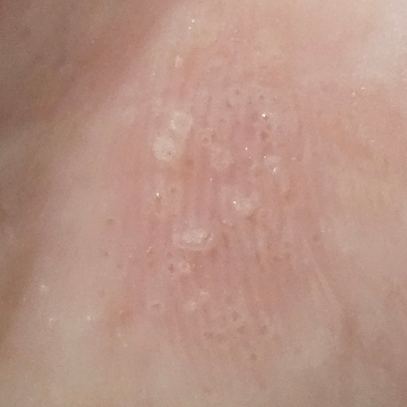 손가락 한포진 수포가 났을 때 습진 일기 손바닥 몸 두드러기 알레르기 병원을 꼭 가야할까? ....