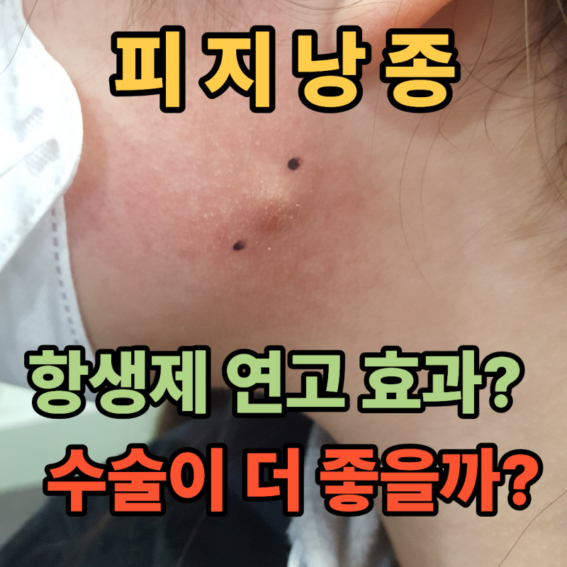 피지낭종 항생제연고 도움될까? 결국 수술하는 이유?(천보성 외과)