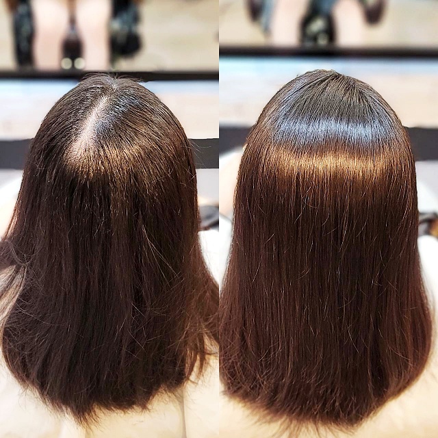  천안에서 수원까지? 20대 후반 가르마 갈라짐 고민, 링거펌 모류교정으로 한 번에 해결될까요?