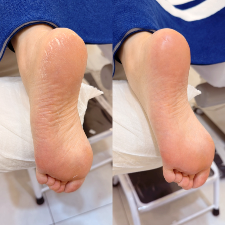  잠실발각질 후기 레푸스 잠실역점｜송파 발뒤꿈치 각질 제거 전후 비교 굳은살 관리 효과