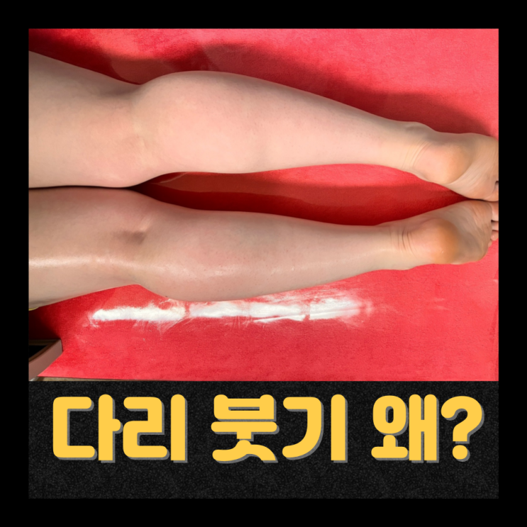  웨딩 전 예신 얼굴 붓기 줄이는 방법 5가지｜신부 웨딩관리준비 천안 신부동피부관리