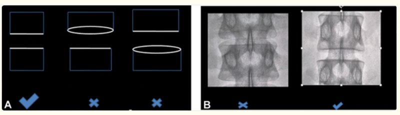 경추간공 경막외 주사 (Transforaminal epidural steroid injection, TFESI) : 네이버 블로그