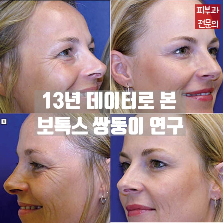 같은 유전자, 다른 얼굴... 13년간 차이는 보톡스밖에 없었다! (보톡스 쌍둥이연구 리뷰)