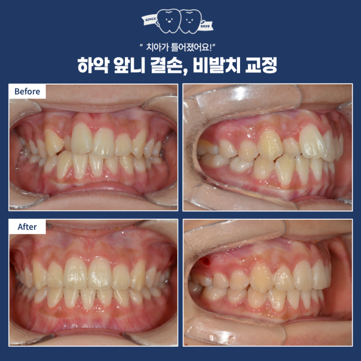  아래 앞니 결손(앞니결손)인 경우 교정치료 옵션? 비발치로 해결하기! 하남 결손치교정