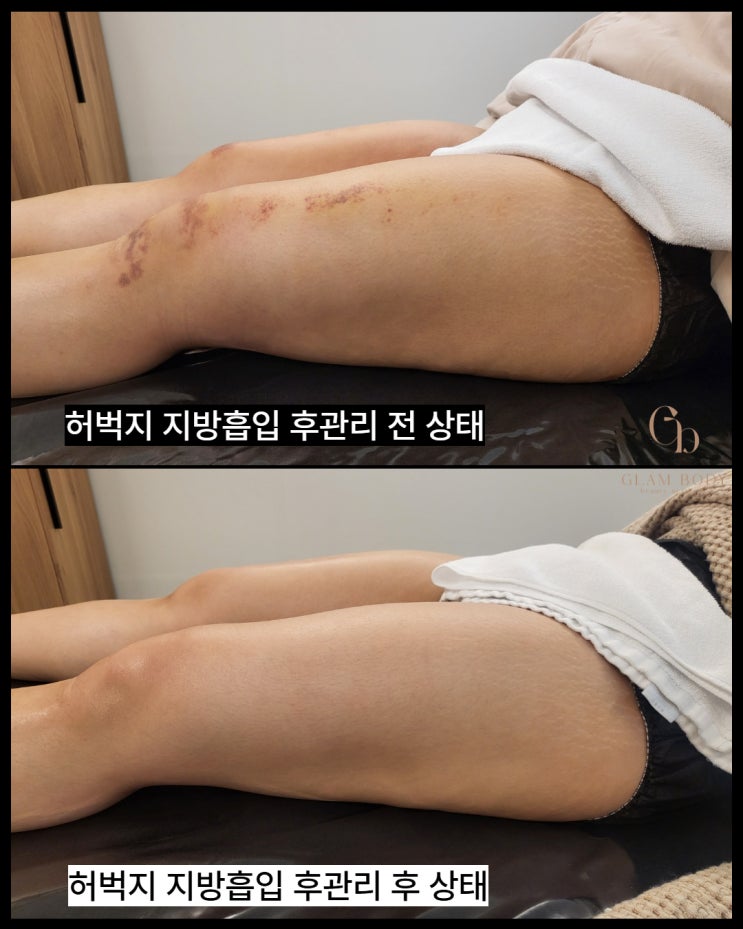  허벅지지방흡입 후관리 2주차, 붓기,속바본 정리하면 라인이 이렇게 달라집니다 (전후 변화)
