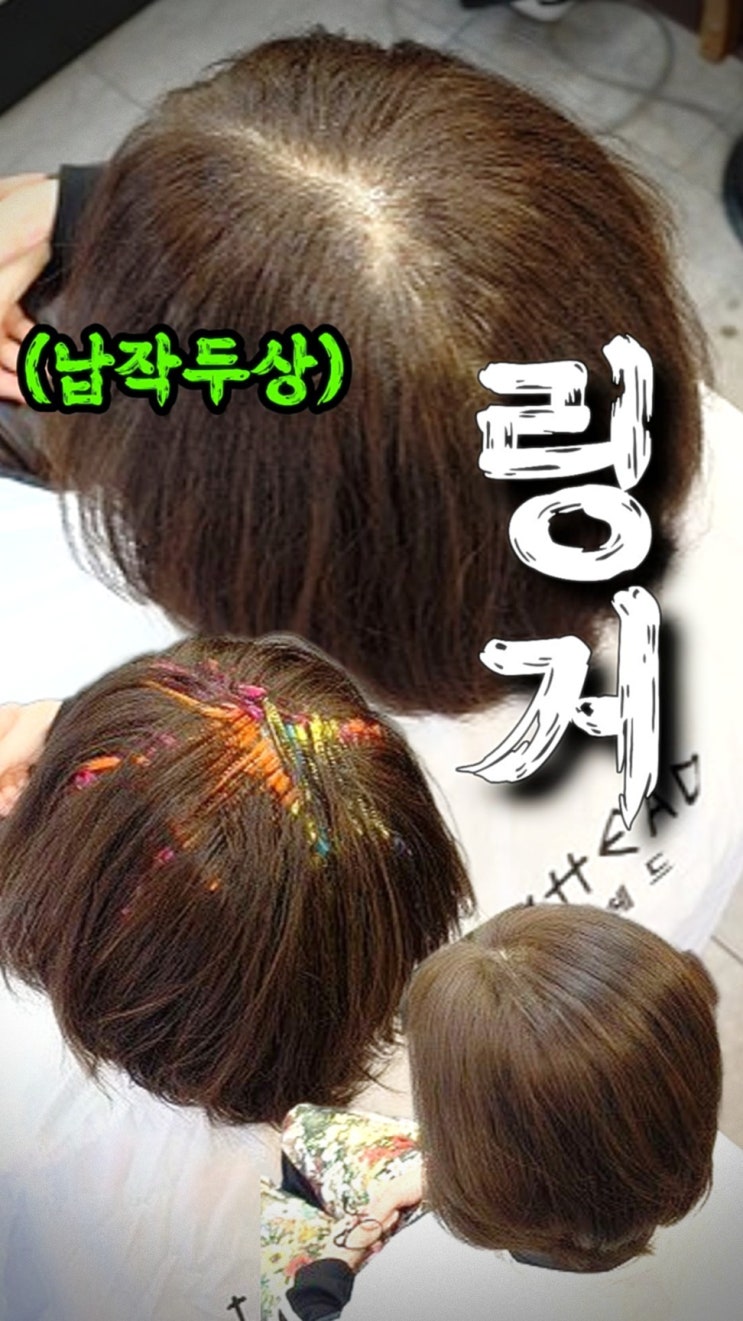  평택 모류교정 링거펌 찾다가 수원까지 온 이유, 정수리볼륨 확실한 후기