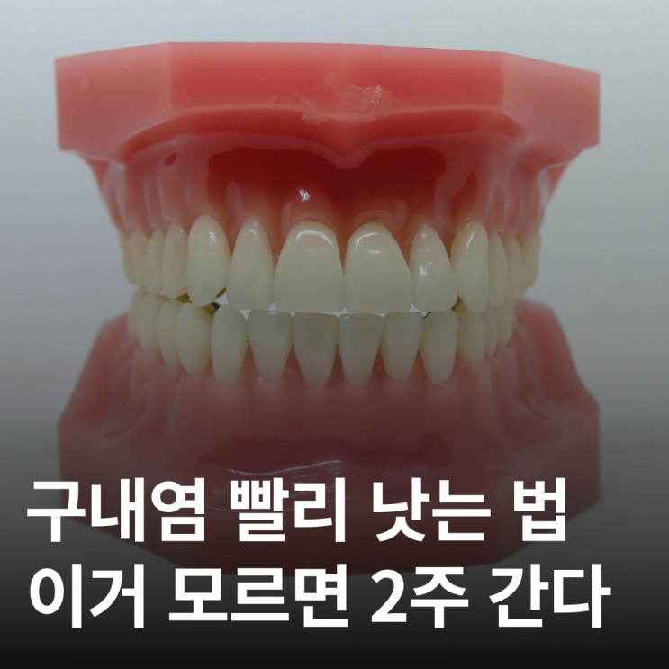  구내염 하루라도 빨리 낫고 싶다면 꼭 보세요