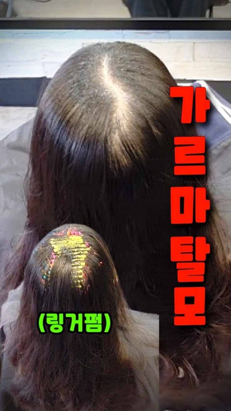  평택 가르마탈모 고민 해결! 정수리볼륨펌으로 뿌리부터 살린 리얼 후기