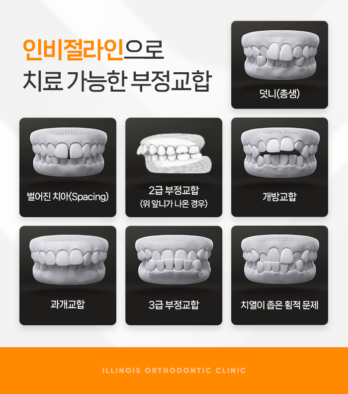 서초구 잠원동에 있는 치아교정 치과 인비절라인으로 가능한 부정교합 치료