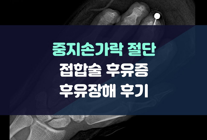중지손가락 절단 접합술 후유증 후유장해 청구 후기(1130만원 보상비결)