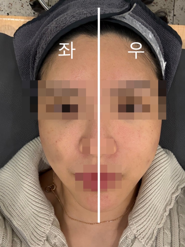 부산 올타이트리프팅 잘하는곳 연예인피부관리 요즘 핫한 리프팅 후기(가격, 효과, 통증, 유지기간 등)
