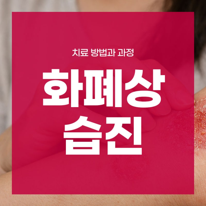 화폐상습진 치료 방법과 과정 한의사가 설명해드립니다