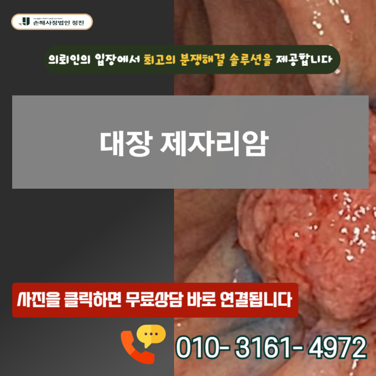  대장 제자리암 , 보험사는 절대 말하지 않는 100% 지급 기준