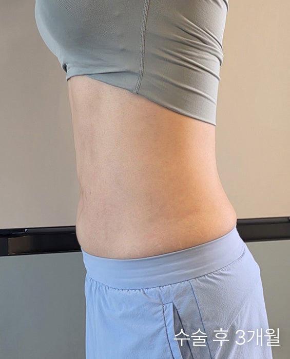  복부지방흡입붓기 언제부터 효과 보일까? 라인 변화와 회복기간 총정리