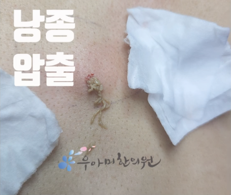 엉덩이 종기 원인, 단순 뾰루지 아닐 수 있습니다｜약•고약•수술 기준 정리