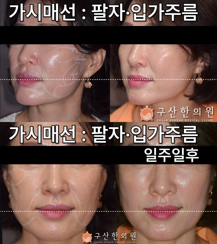  포항 한의원 추천, 통증만 볼지 얼굴까지 볼지에 따라 달라집니다<한방 실리프팅>
