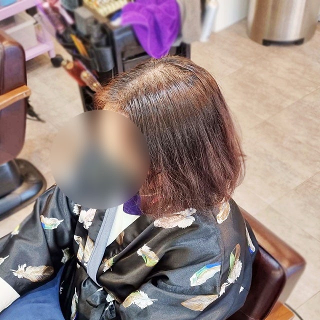  광교 가르마 갈라짐 고민, 원형 탈모처럼 휑한 가마도 링거펌 모류교정으로 지워질까요?