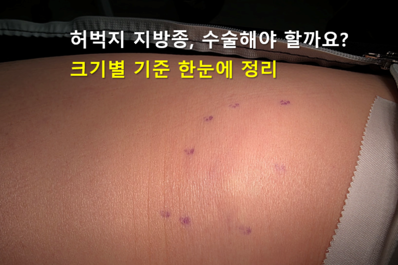 허벅지 지방종 수술 필요할까? 크기별 기준 정리