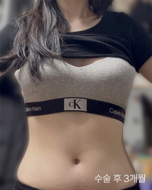 복부지방흡입비용 비교 전 필수 체크! 통증과 회복 기간 줄이는 법