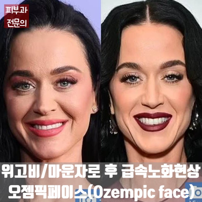  살은 빠졌는데 얼굴은 늙어 보여요...  위고비/마운자로 후 얼굴 쳐짐, 오젬픽페이스(Ozempic face)의 모든 것