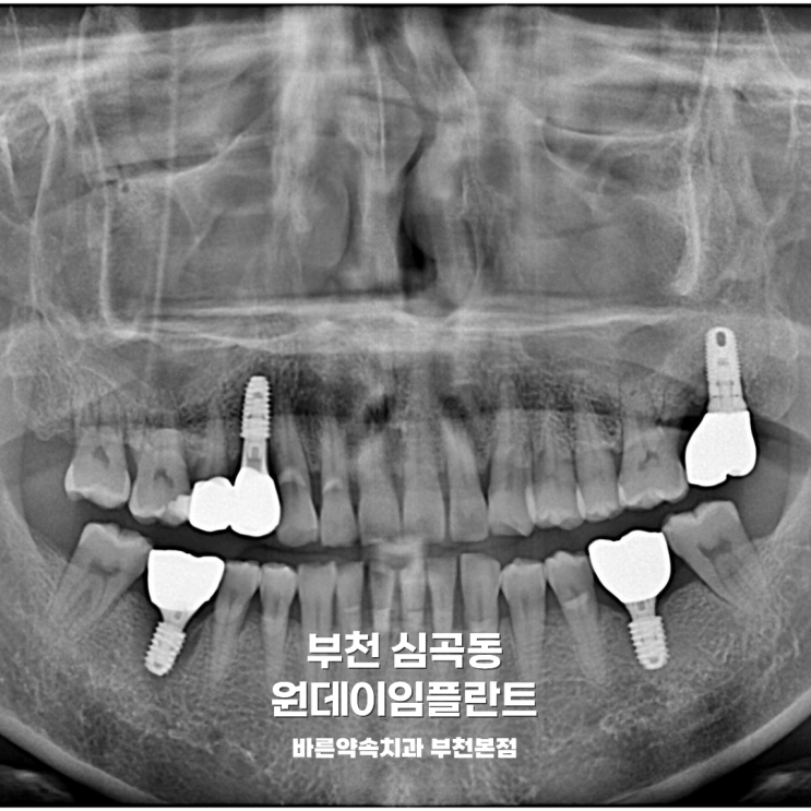 부천 심곡동 원데이임플란트 :: 최소내원으로 완성하는