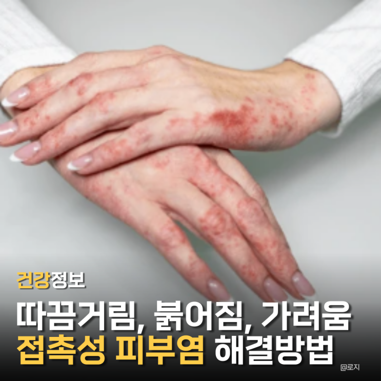  접촉성 피부염 증상 따끔거림, 붉어짐, 가려움 원인과 해결방법