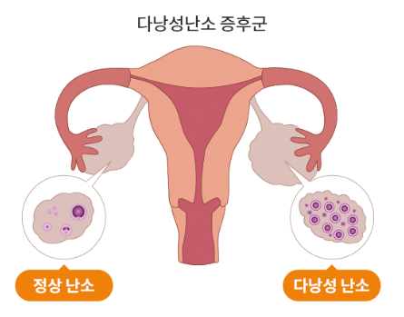 다낭성난소증후군 검사 초음파 방법 결과 총정리