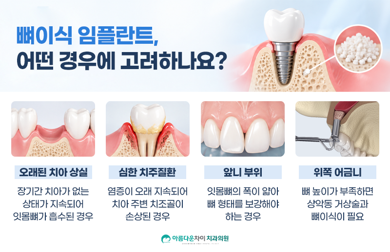 대구치과 임플란트 뼈이식, 필요한 경우와 진행 과정