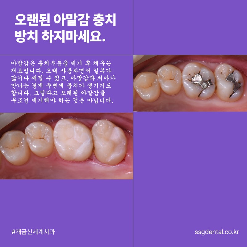 주례역 오래된 아말감 충치 방치하지 마세요.
