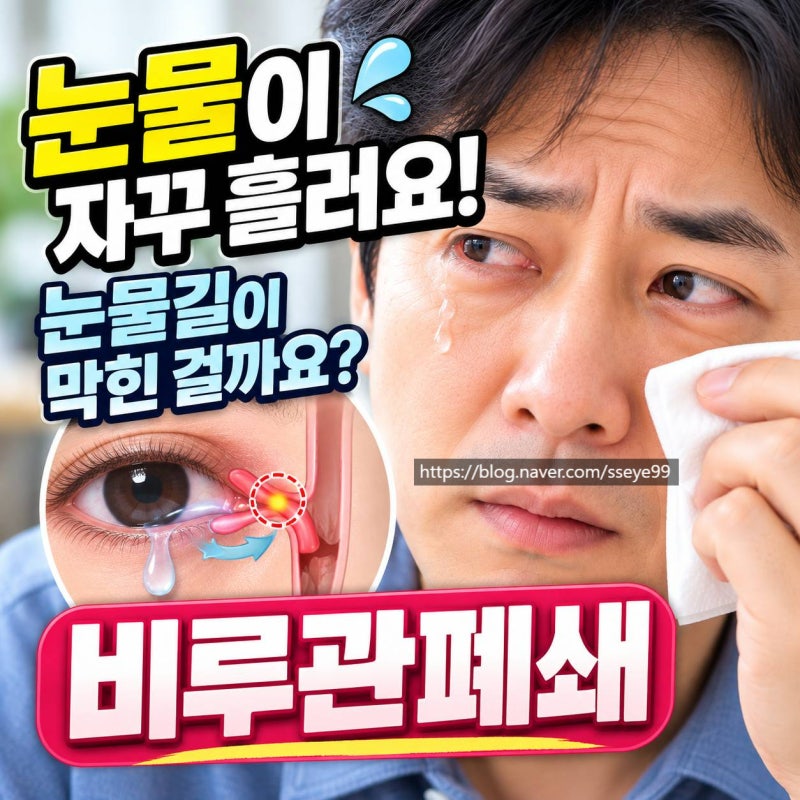 송탄안과 눈물이 자꾸 흘러요, 눈물길이 막힌 걸까요? 비루관폐쇄(코눈물관폐쇄) 원인부터 ....