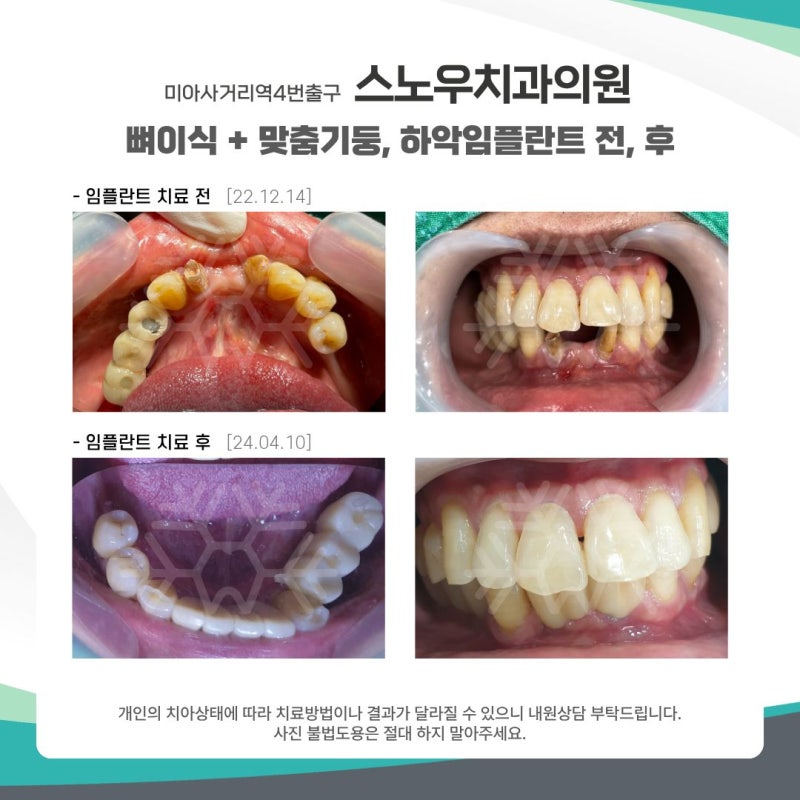 2026년 임플란트 건강보험 적용 나이부터 비용까지 총정리