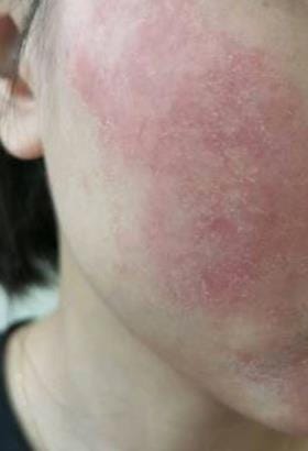 얼굴 지루성 피부염 스테로이드 연고 언제까지 의지할건가요?