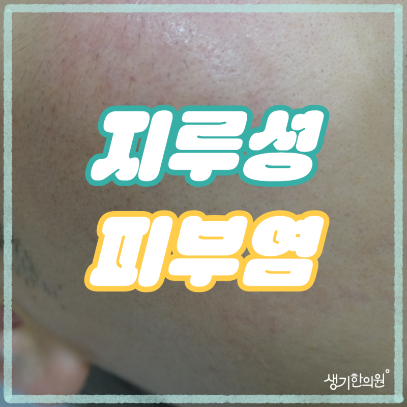 도봉구지루성피부염, 면도하고 나면 코 옆과 턱이 붉게 일어나는 남자라면