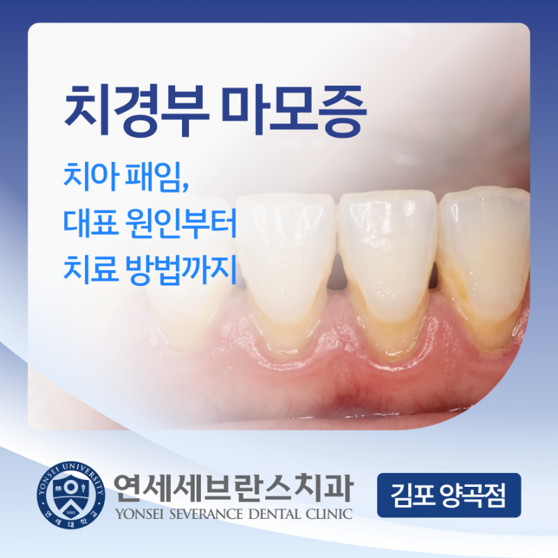 치경부 마모증(치아 패임) 대표 원인부터 치료 방법까지 – 김포 운양동 치과