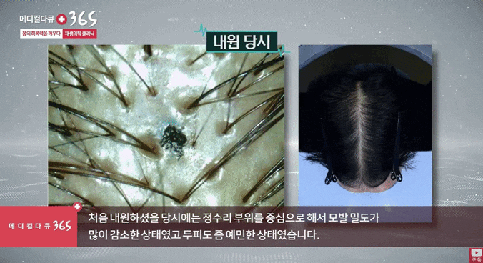 부산탈모치료, 약보다 먼저 확인할 게 있습니다