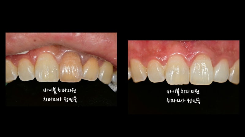 앞니 신경치료 후 변색, 꼭 크라운 씌워야 하나요? 검게 변한 치아의 실활치 미백