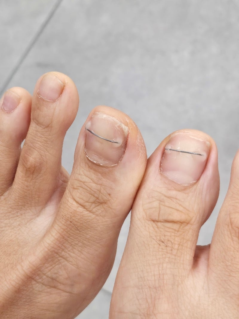 하남미사 센트럴자이 근처 무좀관리 내성발톱, 어린이도 관리 가능한 곳