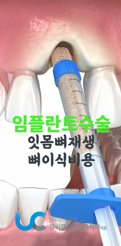 임플란트수술 잇몸뼈재생과 뼈이식비용 차이나는 이유