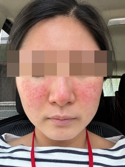 주사피부염(Rosacea) 원인 및 증상 총정리 홈케어 관리법 공개