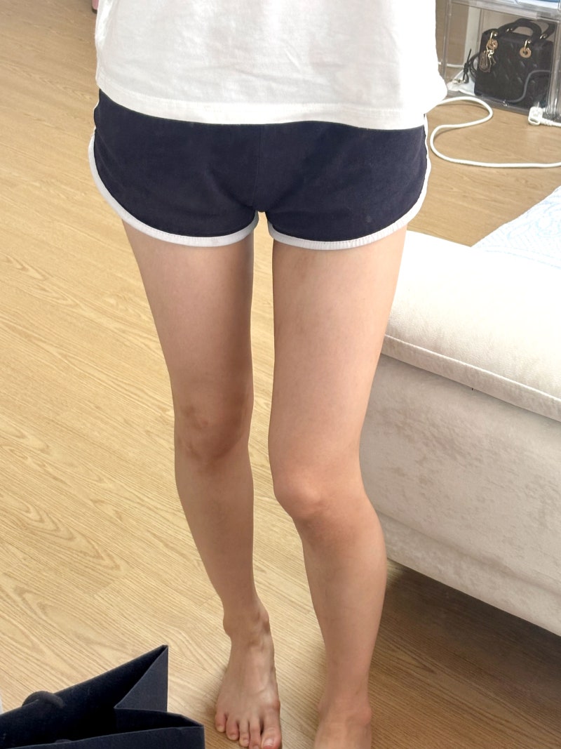 허벅지 안쪽살 빼는 법, 결국 지방흡입을 선택한 이유