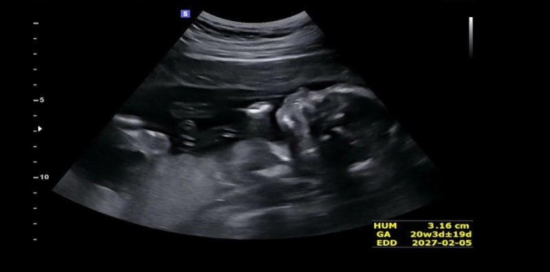 [임신 19주~21주 일기] 21주 5일 차 신체 증상과 임신 소양증, 그리고 4주 뒤 임당 검사 대비